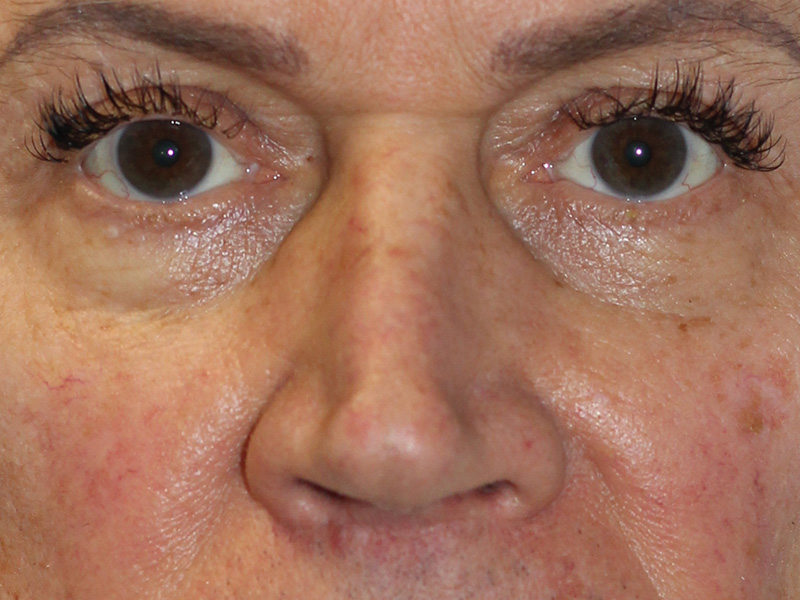 Filler Before and After | PERK Plastic Surgery