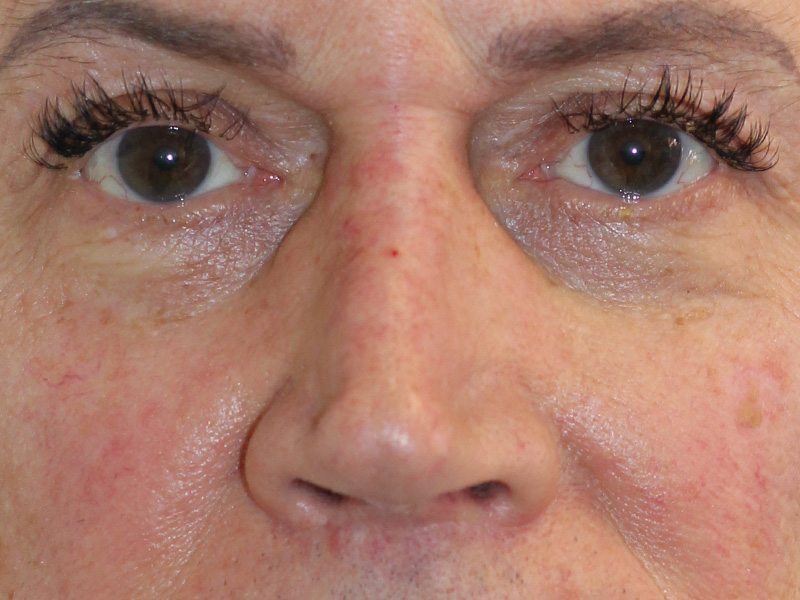 Filler Before and After | PERK Plastic Surgery