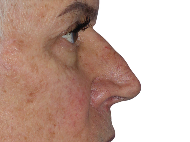 Filler Before and After | PERK Plastic Surgery