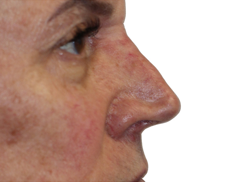 Filler Before and After | PERK Plastic Surgery