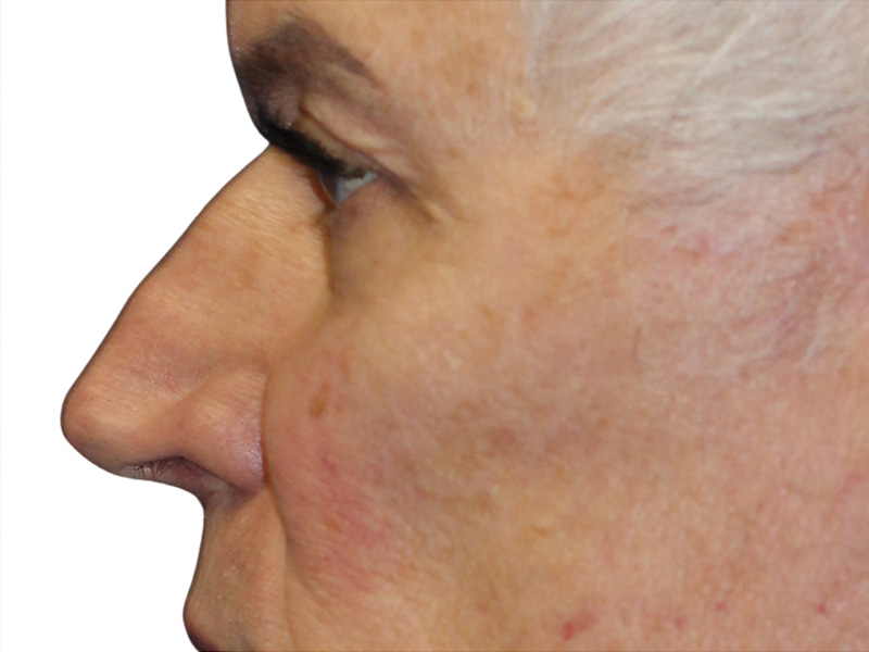 Filler Before and After | PERK Plastic Surgery