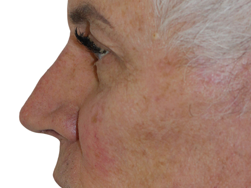 Filler Before and After | PERK Plastic Surgery