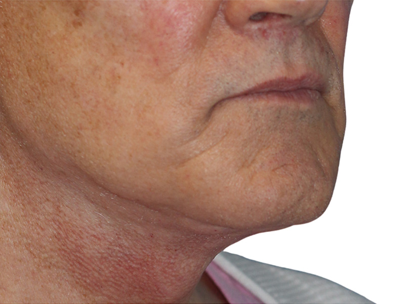 Filler Before and After | PERK Plastic Surgery