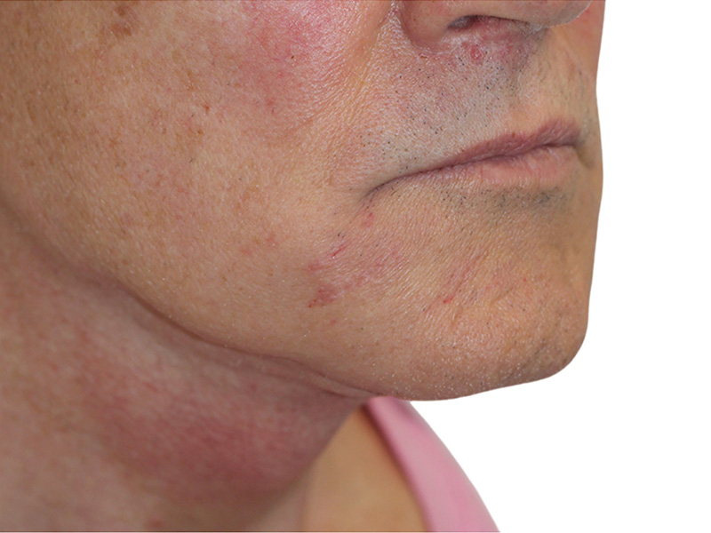 Filler Before and After | PERK Plastic Surgery