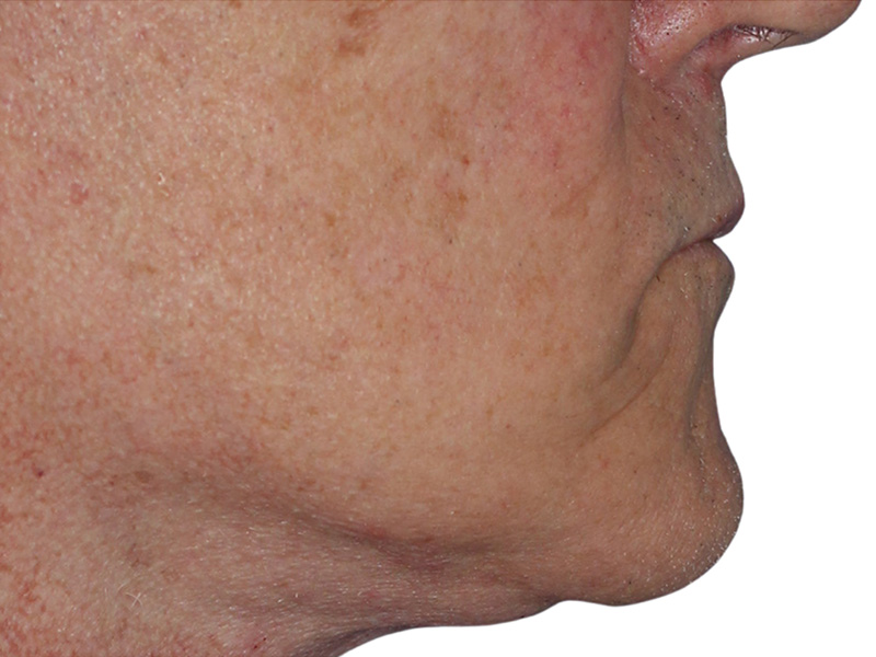 Filler Before and After | PERK Plastic Surgery