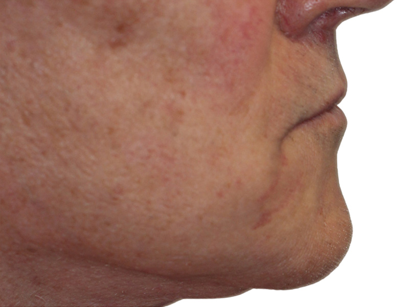 Filler Before and After | PERK Plastic Surgery