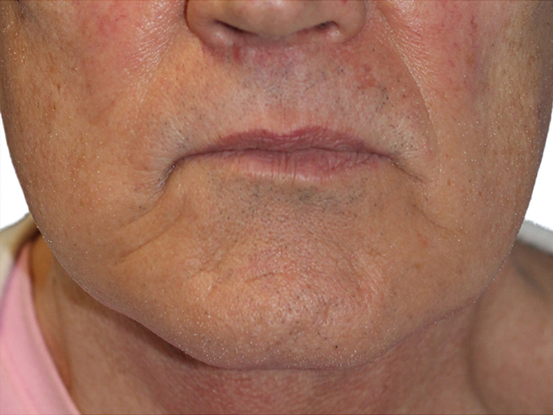 Filler Before and After | PERK Plastic Surgery