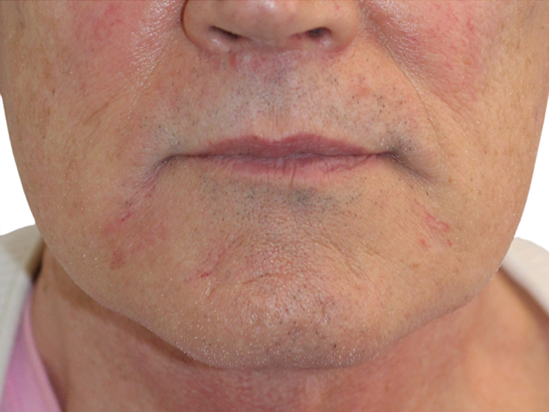 Filler Before and After | PERK Plastic Surgery