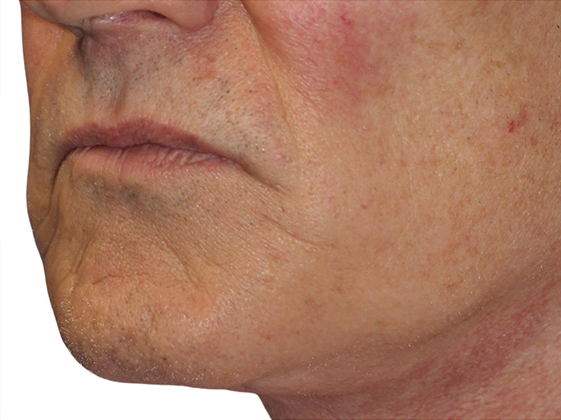 Filler Before and After | PERK Plastic Surgery