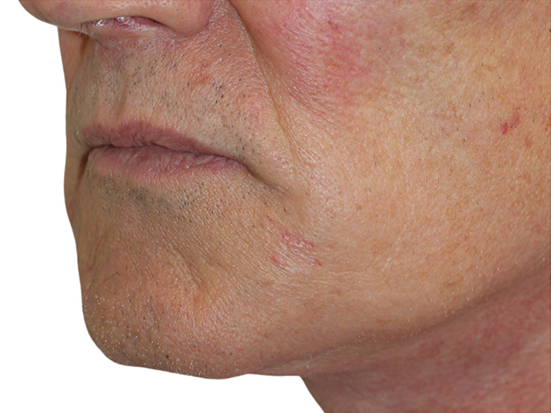 Filler Before and After | PERK Plastic Surgery
