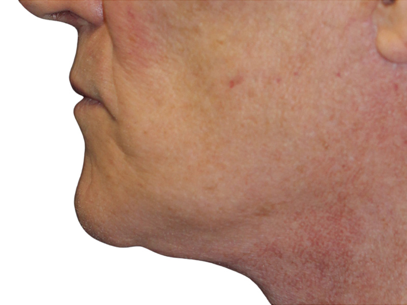 Filler Before and After | PERK Plastic Surgery