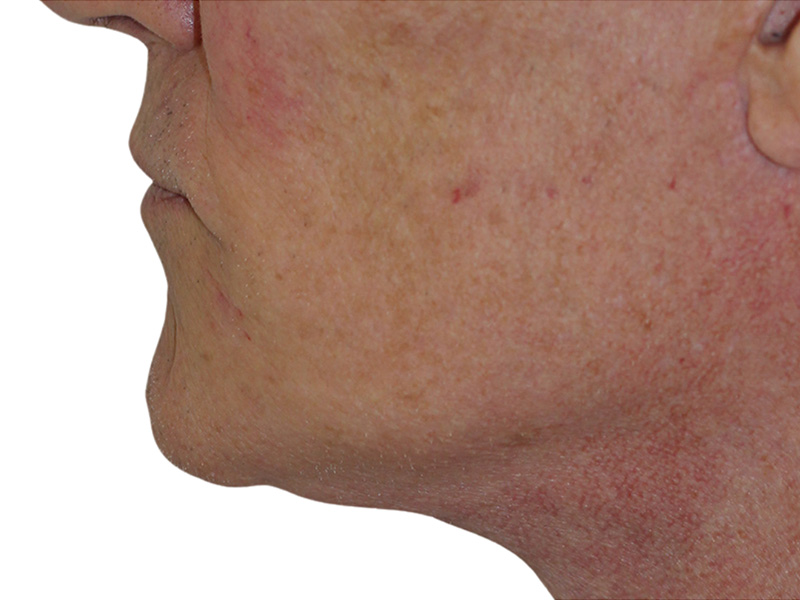 Filler Before and After | PERK Plastic Surgery
