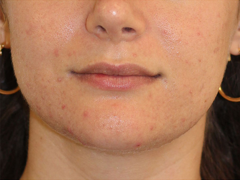 Filler Before and After | PERK Plastic Surgery