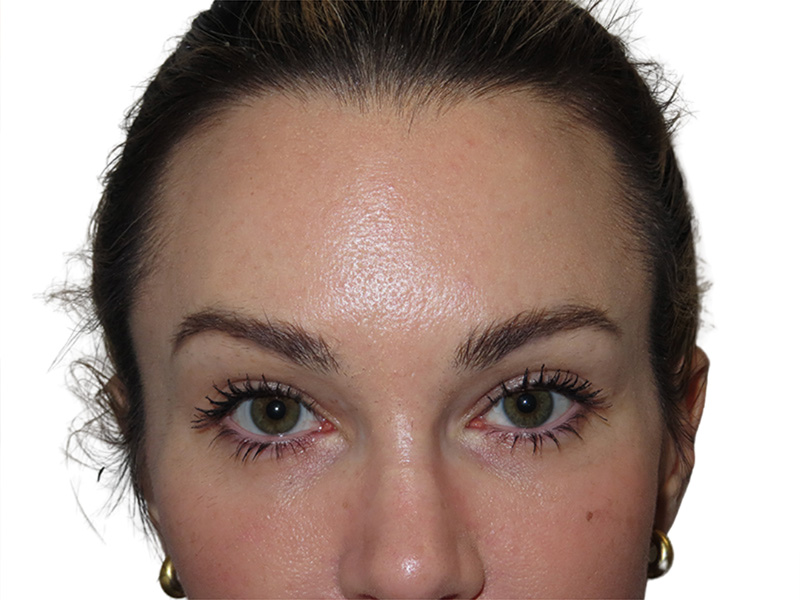 Filler Before and After | PERK Plastic Surgery