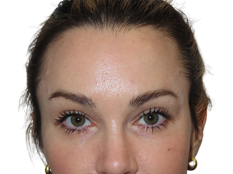 Filler Before and After | PERK Plastic Surgery