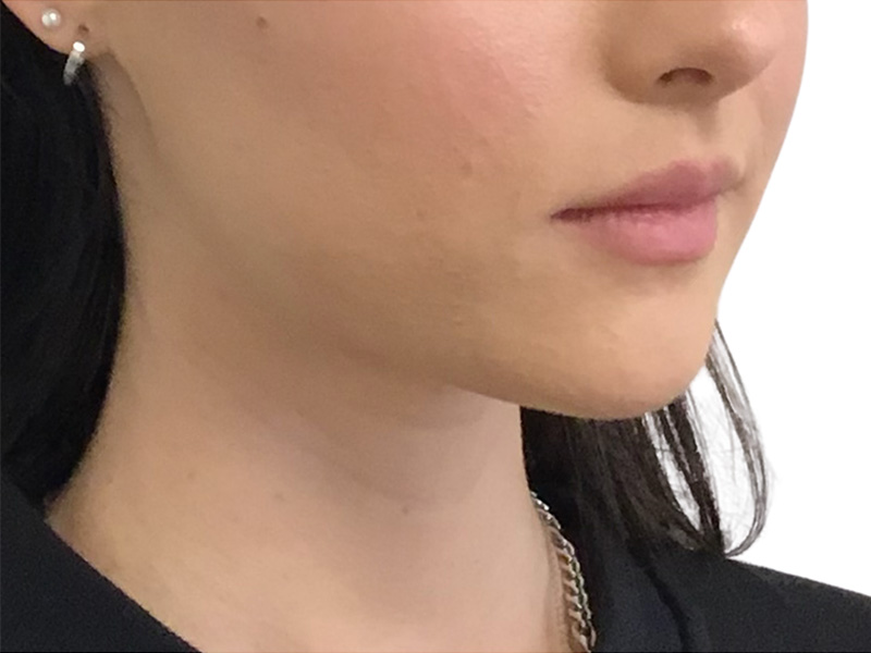 Filler Before and After | PERK Plastic Surgery