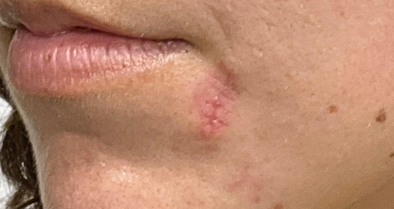 Scar Care Before and After | PERK Plastic Surgery