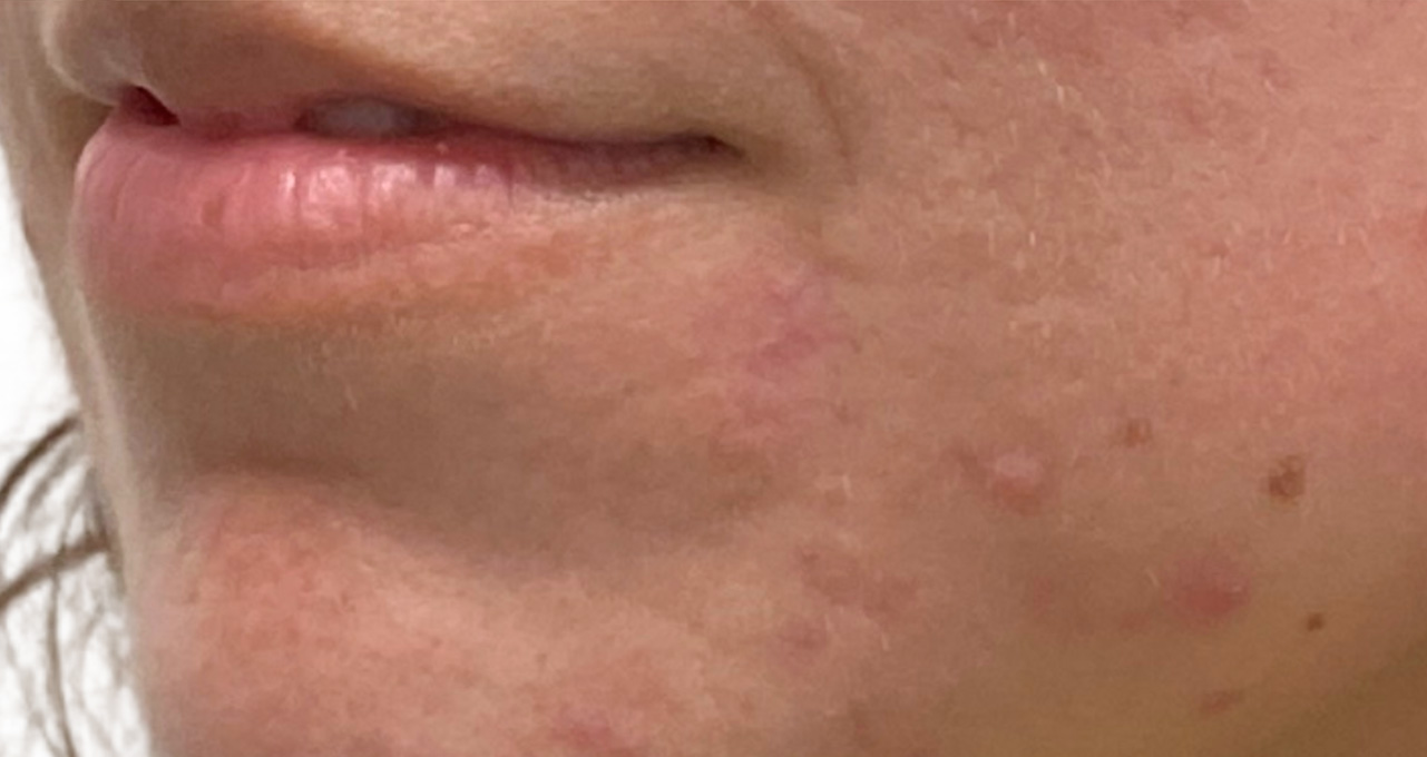 Scar Care Before and After | PERK Plastic Surgery