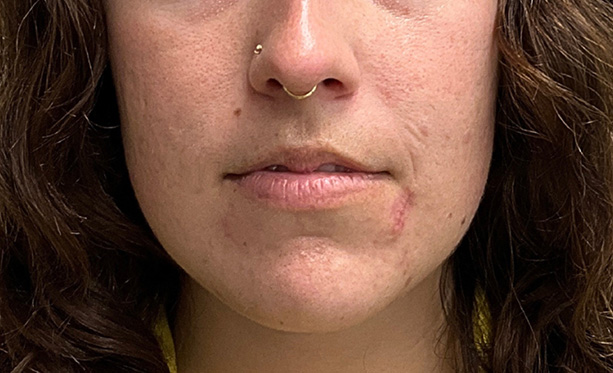 Scar Care Before and After | PERK Plastic Surgery