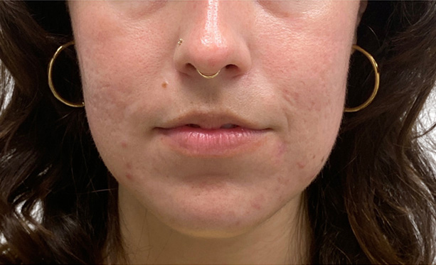 Scar Care Before and After | PERK Plastic Surgery