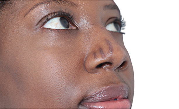 Scar Care Before and After | PERK Plastic Surgery