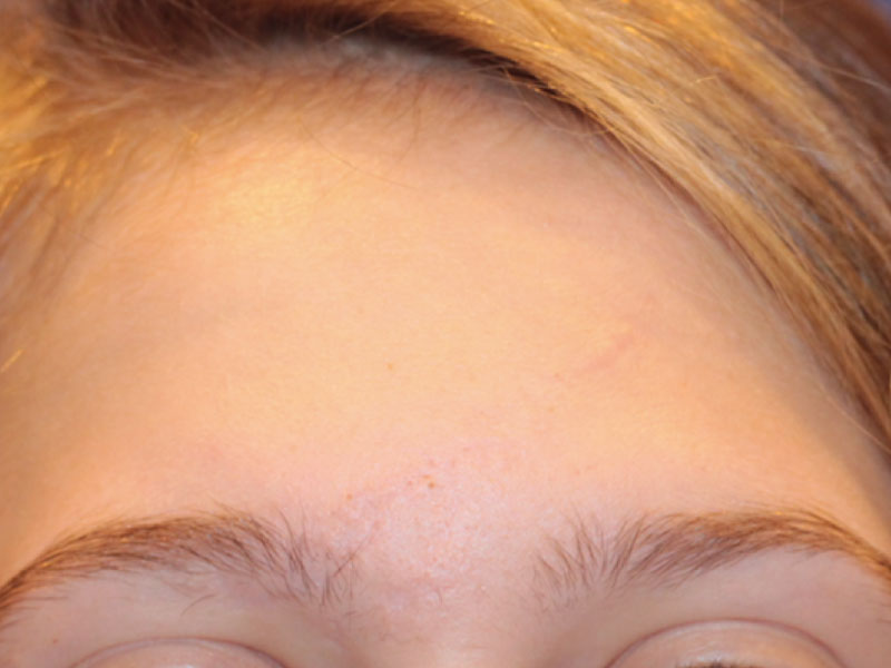 Scar Care Before and After | PERK Plastic Surgery