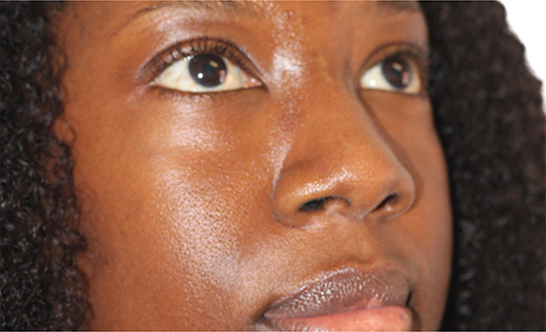 Scar Treatment Beverly Hills