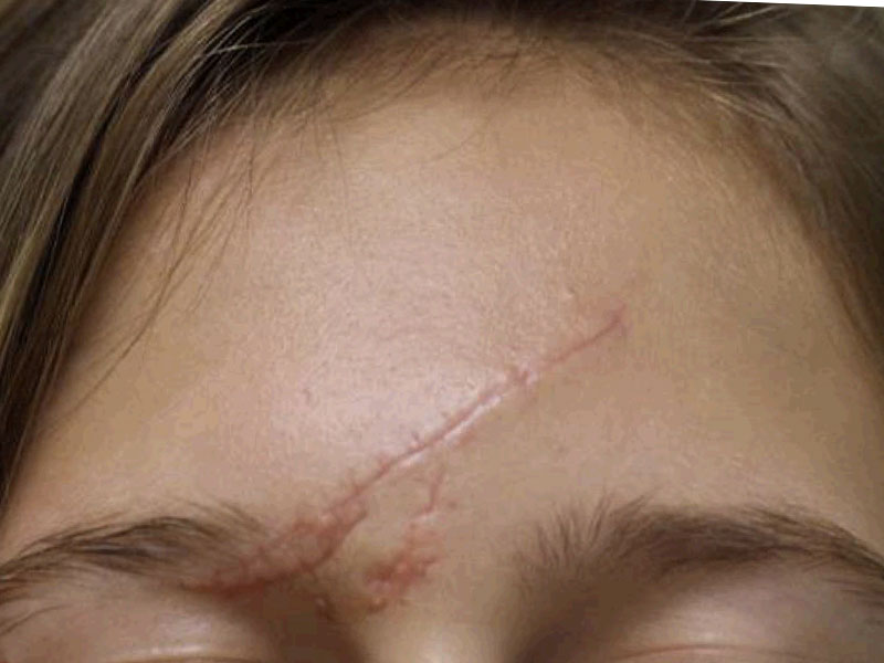 Scar Care Before and After | PERK Plastic Surgery