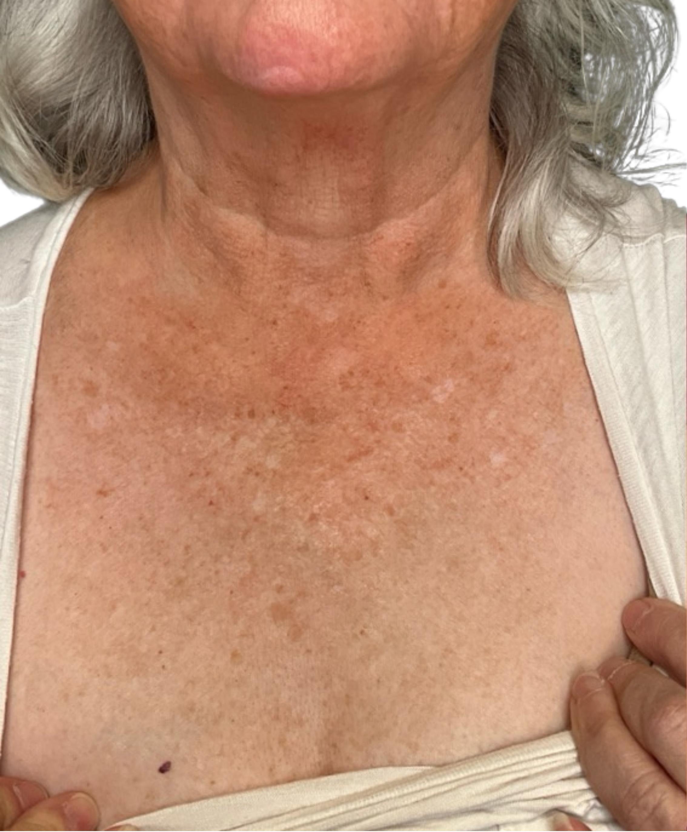 Skin Transformation Before and After | PERK Plastic Surgery