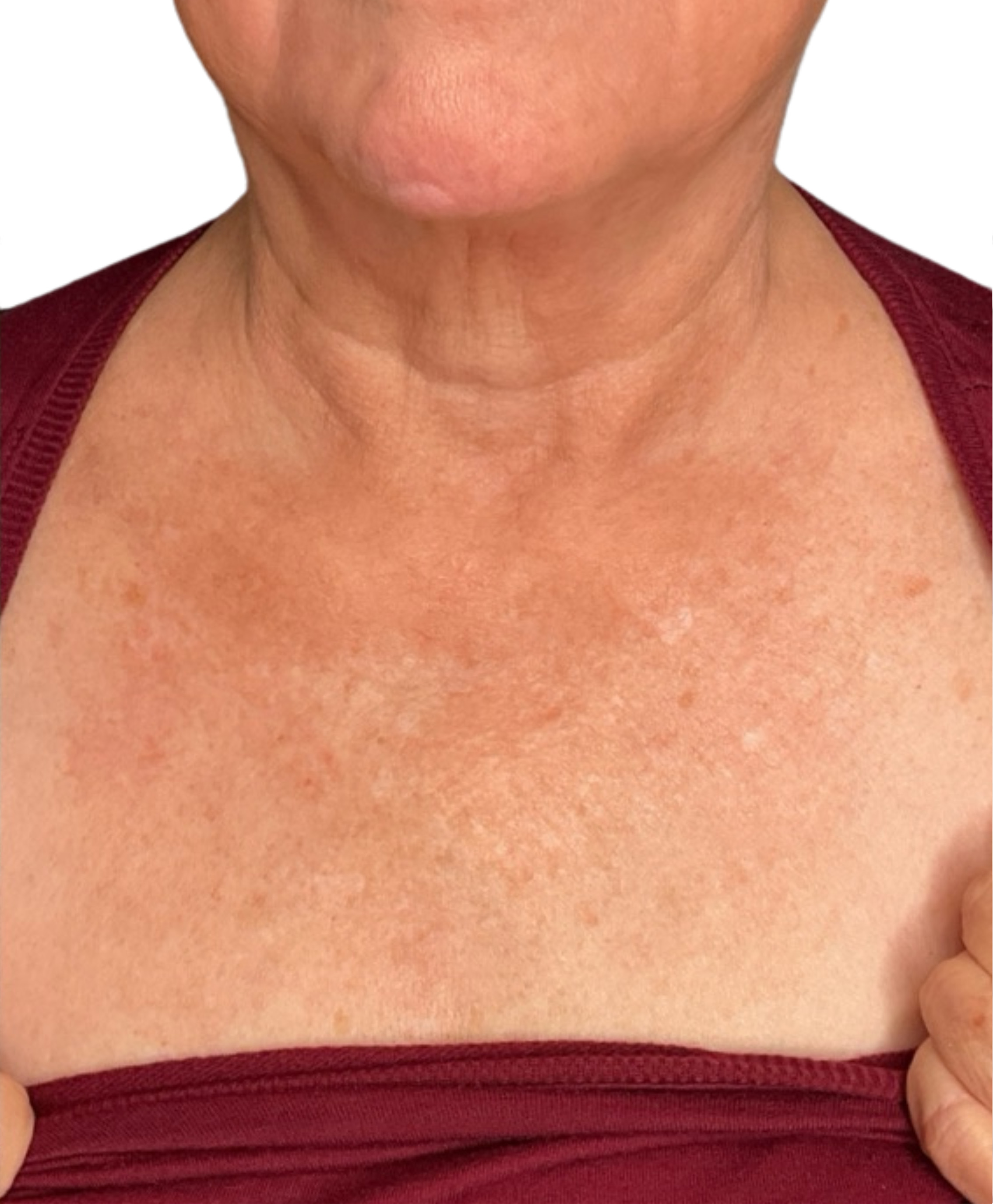 Skin Transformation Before and After | PERK Plastic Surgery