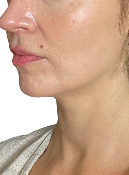 Skin Transformation Before and After | PERK Plastic Surgery