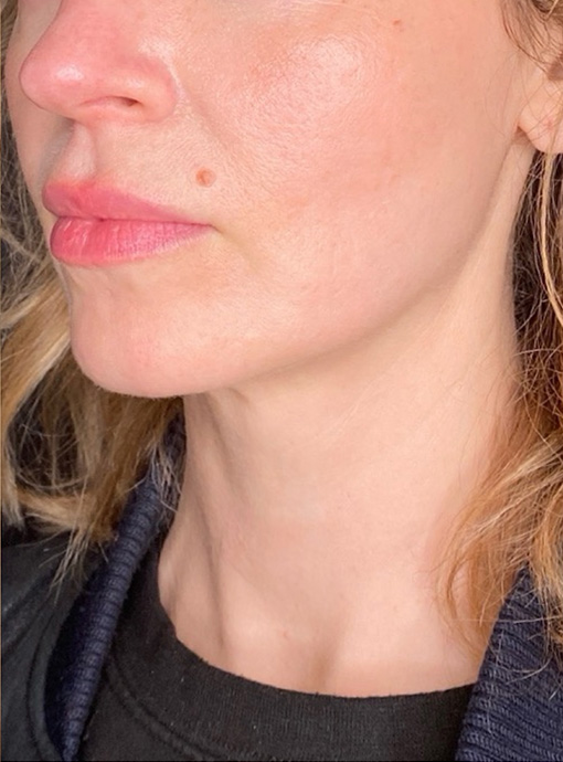 Skin Transformation Before and After | PERK Plastic Surgery
