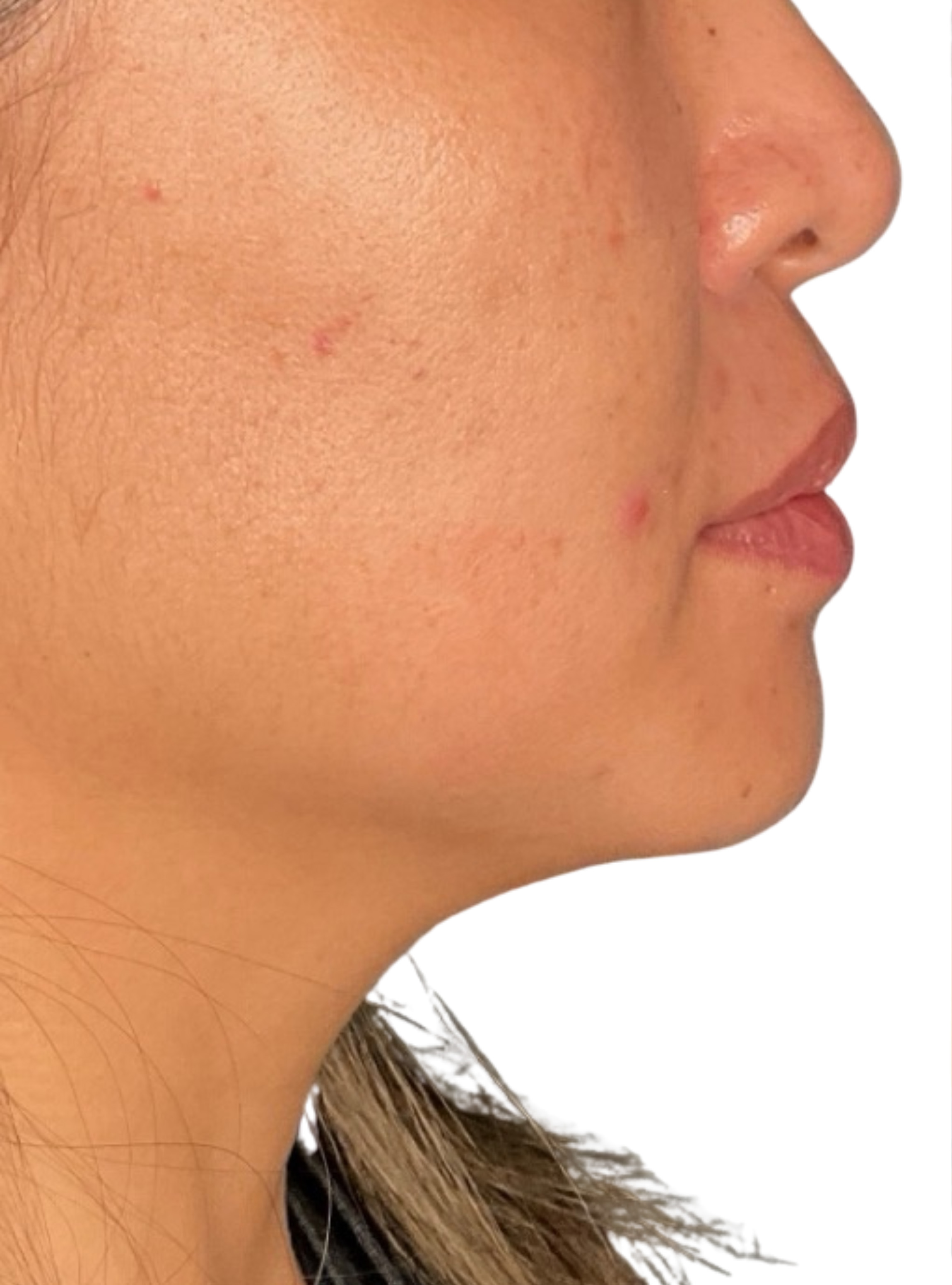 Skin Transformation Before and After | PERK Plastic Surgery