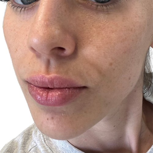 Skin Transformation Before and After | PERK Plastic Surgery