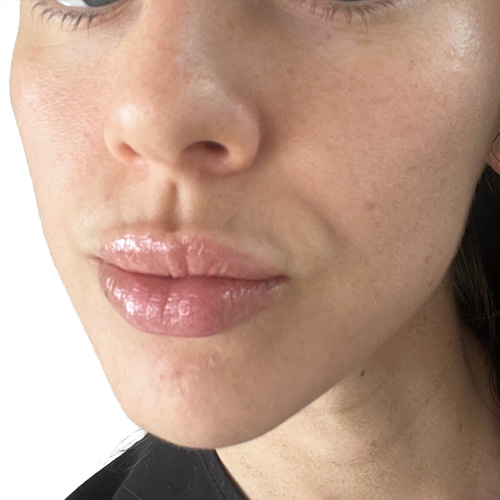 Skin Transformation Before and After | PERK Plastic Surgery
