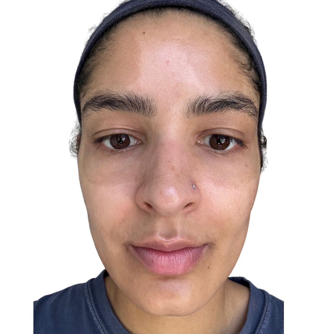 Skin Transformation Before and After | PERK Plastic Surgery