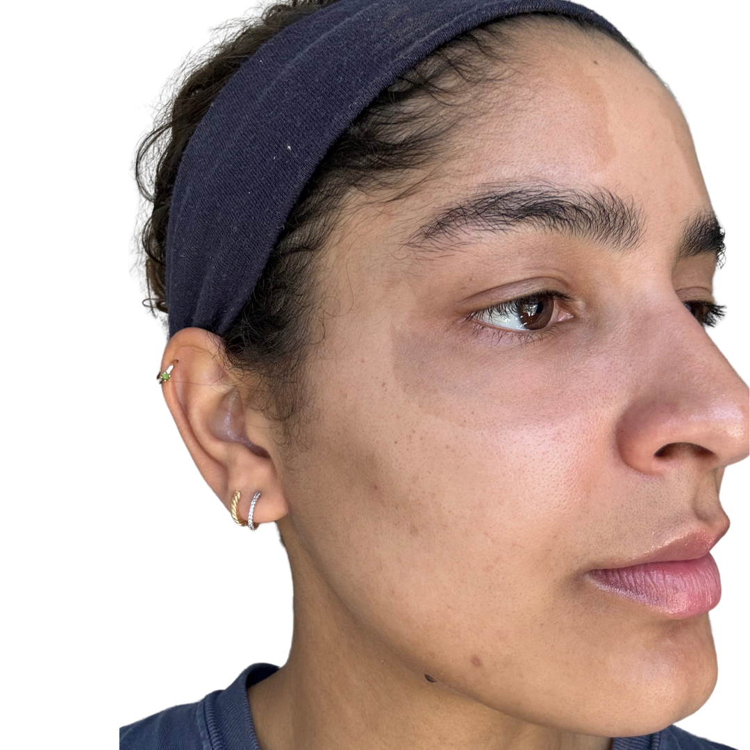 Skin Transformation Before and After | PERK Plastic Surgery