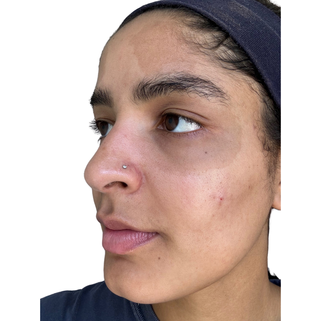 Skin Transformation Before and After | PERK Plastic Surgery