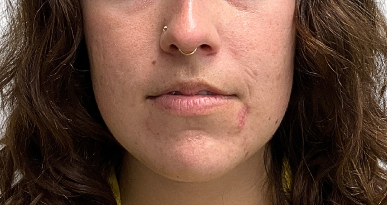 Skin Transformation Before and After | PERK Plastic Surgery