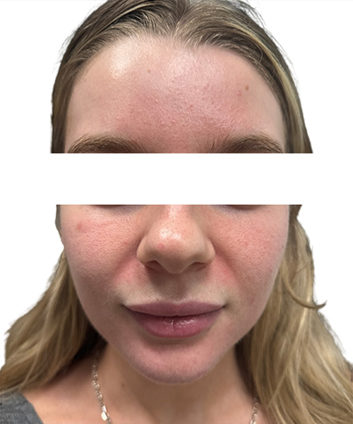 Skin Transformation Before and After | PERK Plastic Surgery