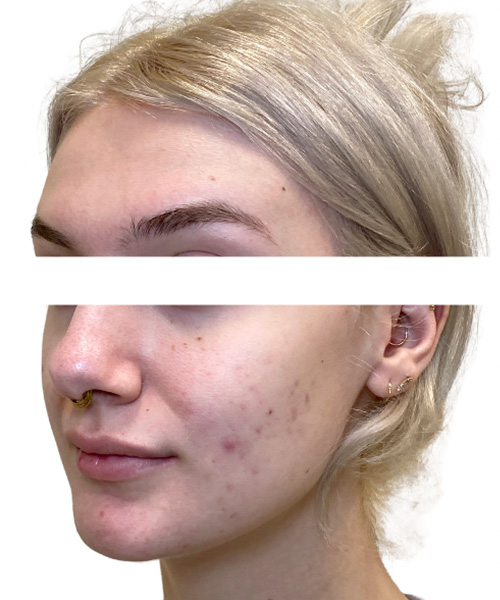 Skin Transformation Before and After | PERK Plastic Surgery