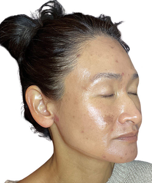 Skin Transformation Before and After | PERK Plastic Surgery