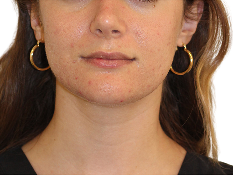 Skin Transformation Before and After | PERK Plastic Surgery