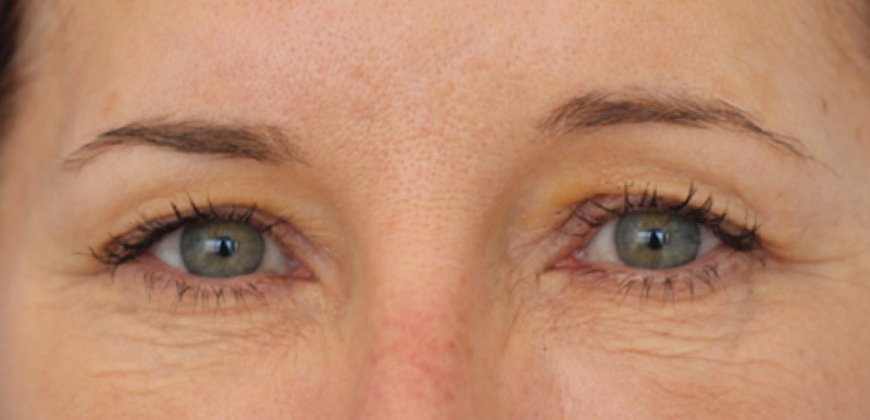 Skin Transformation Before and After | PERK Plastic Surgery