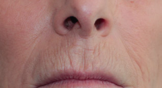 Skin Transformation Before and After | PERK Plastic Surgery