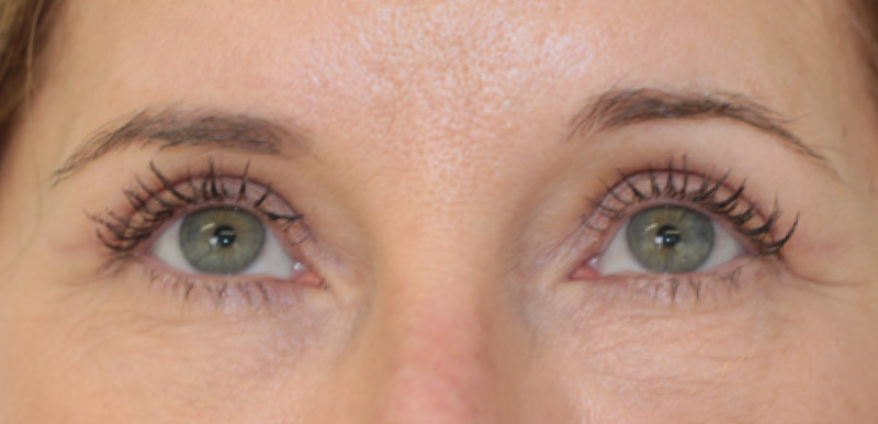 Skin Transformation Before and After | PERK Plastic Surgery