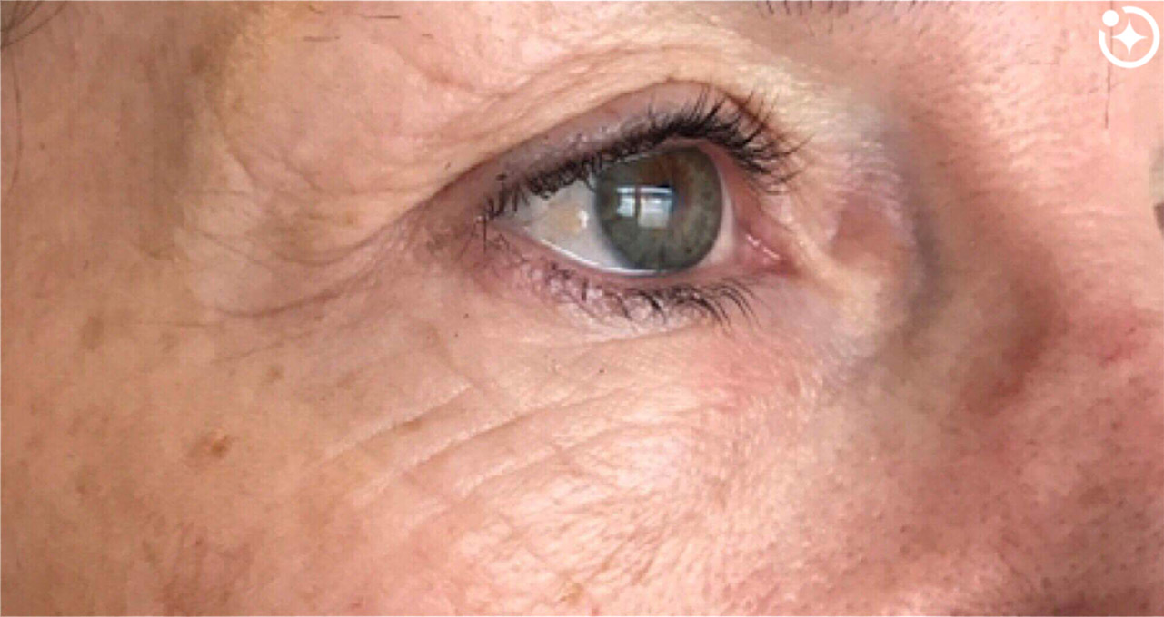 Skin Transformation Before and After | PERK Plastic Surgery
