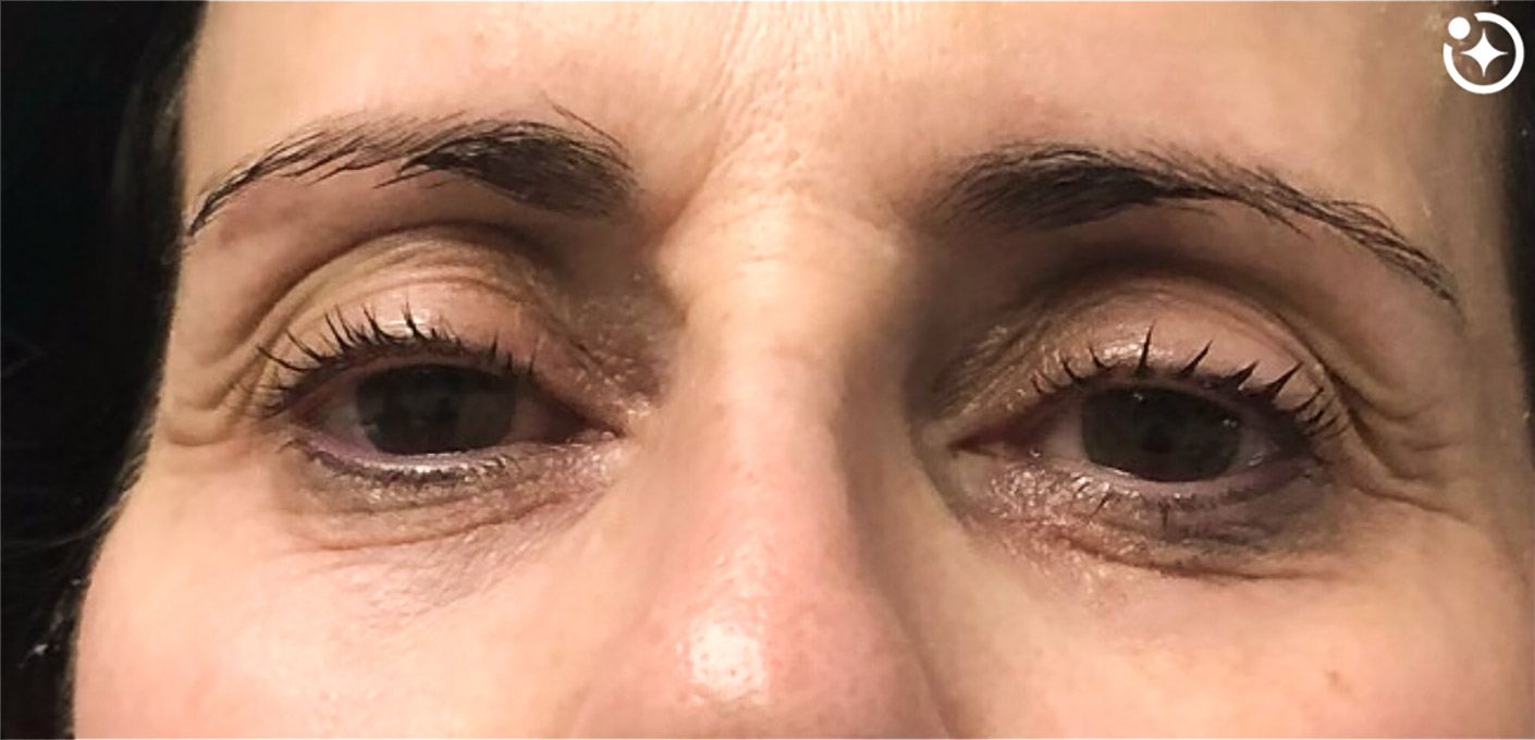 Skin Transformation Before and After | PERK Plastic Surgery
