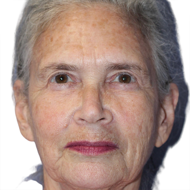 Skin Transformation Before and After | PERK Plastic Surgery