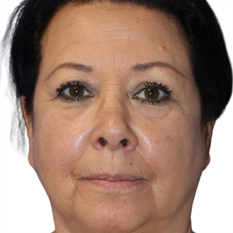 Skin Transformation Before and After | PERK Plastic Surgery